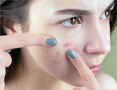 Your Skin and Cystic Acne